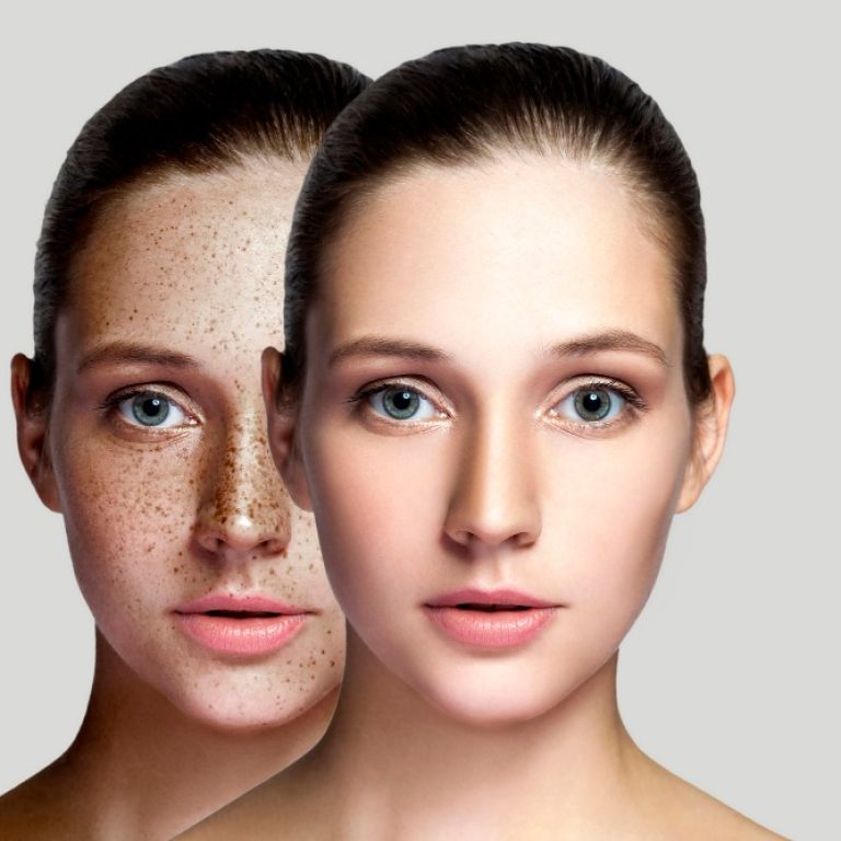 inci-tozu-leke-bakimi